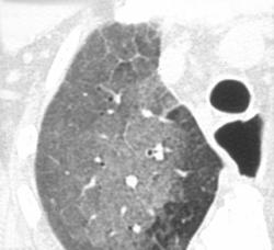 Lipoid Pneumonia in Patient With Achalasia - CTisus CT Scan