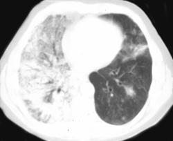 Alveolar Cell Lung Cancer - CTisus CT Scan