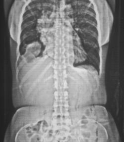 Thymoma With Pleural and Diaphragmatic Abscess - CTisus CT Scan