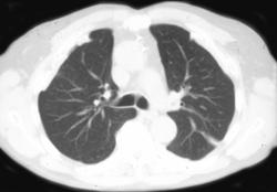 Calcified Pleural Plaques - CTisus CT Scan