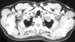 Neurofibromas - CTisus CT Scan