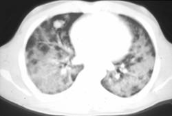 Drug Reaction to Chemotherapy - CTisus CT Scan