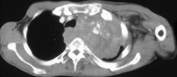 Thymic Carcinoma - CTisus CT Scan