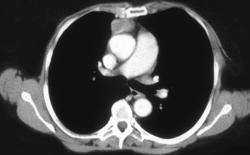 Thymoma - CTisus CT Scan