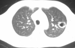 Cavity Secondary to Tuberculosis (TB) - CTisus CT Scan