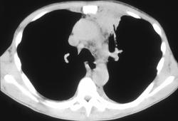 Actinomycosis Involves Pericardium and Mediastinum - CTisus CT Scan