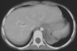 Pulmonary Sequestration - CTisus CT Scan