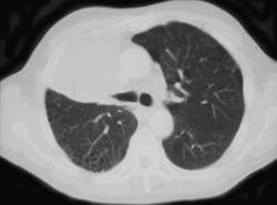 RUL Carcinoma (NSCLC) - CTisus CT Scan