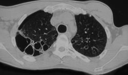 Blebs Following Several Episodes of PCP - CTisus CT Scan