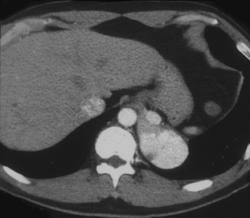 Extralobar Sequestration - CTisus CT Scan