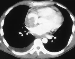 Lymphoma Involves the Right Atrium - CTisus CT Scan