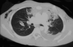 Mediastinal Trauma - CTisus CT Scan