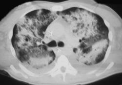 Cytomegalovirus (CMV) Pneumonia - CTisus CT Scan