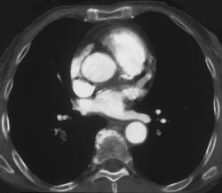 Pulmonary Embolism - CTisus CT Scan