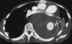 Leaking Aortic Aneurysm - CTisus CT Scan