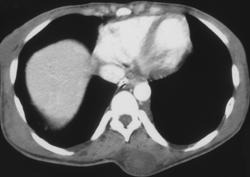 Lymphoma (AIDS Patient) - CTisus CT Scan