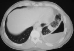 Bronchopleural Fistulae - CTisus CT Scan