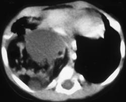 Dermoid - CTisus CT Scan