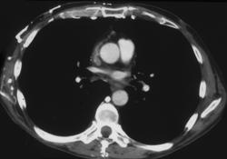 SVC Occlusion- Lymphoma - CTisus CT Scan