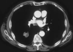 Adenocarcinoma - CTisus CT Scan