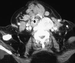 Goiter - CTisus CT Scan