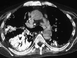 S/P Fluorocarbon Therapy - CTisus CT Scan