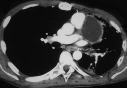 Cystic Thymoma - CTisus CT Scan