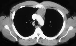 Primary Mediastinal Germ Cell Tumor - CTisus CT Scan