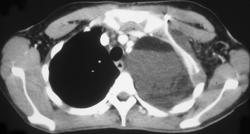 Chylothorax - CTisus CT Scan