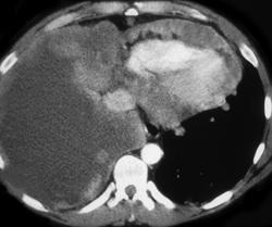 Melanoma Infiltrates the Heart and Pleura - CTisus CT Scan