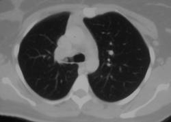 Mucoepidermoid Carcinoma - CTisus CT Scan