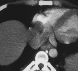 Right Atrial Thrombus - CTisus CT Scan