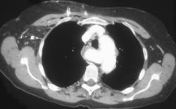 Aneurysm of Aberrant Right Subclavian Artery - CTisus CT Scan