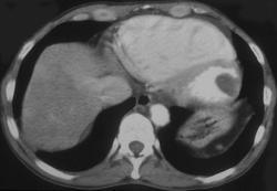 Clot in Left Ventricle - CTisus CT Scan