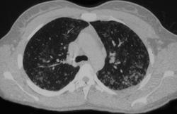 Sarcoidosis - CTisus CT Scan