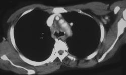 Breast Cancer With Nodes - CTisus CT Scan