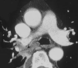 Intraluminal Mucus Plug - CTisus CT Scan