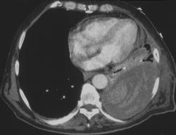 Bleed in Pleural Space - CTisus CT Scan