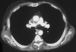 SVC Thrombus - CTisus CT Scan