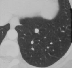 Calcified Lung Nodule - CTisus CT Scan