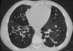 Bronchiectasis - CTisus CT Scan