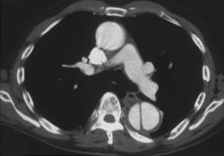 Aortic Dissection - CTisus CT Scan