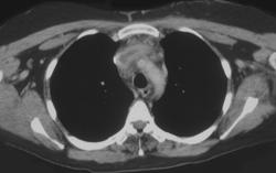 SVC Syndrome - CTisus CT Scan