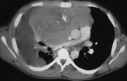 Teratoma - CTisus CT Scan