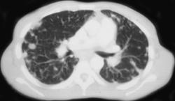 Actinomycosis - CTisus CT Scan