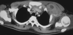 Lymphoma - CTisus CT Scan