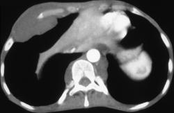 Neurofibromatosis - CTisus CT Scan