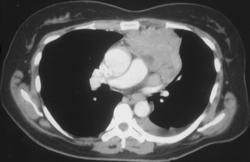 Lymphoma - CTisus CT Scan