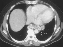 Esophageal Varices - CTisus CT Scan