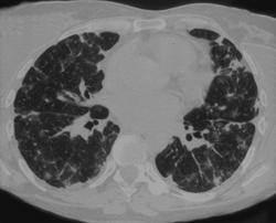 Lymphatic Spread of Tumor - CTisus CT Scan